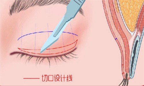 西安藝星宋蔚做雙眼皮技術(shù)穩(wěn)定靠譜，美杜莎6D明星眼8000起自然有神韻