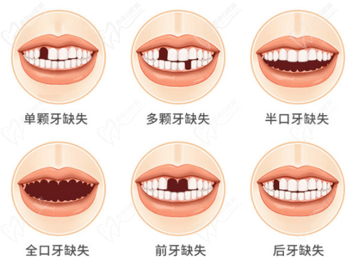 種植牙適應(yīng)癥