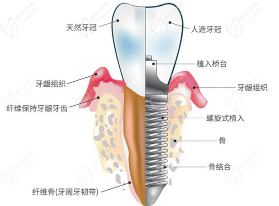 成都錦江極光口腔韓國(guó)DIO種植