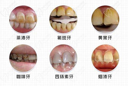 牙齒美白適應癥