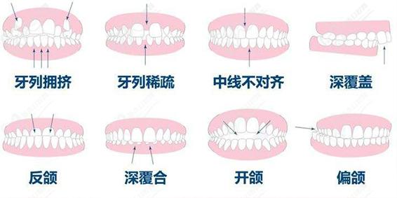 口腔矯正適應(yīng)人群