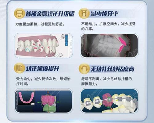 奧姆科自鎖托槽矯正優(yōu)勢