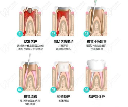 根管治療