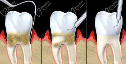 牙周炎