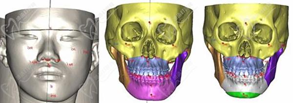 廣州穗華口腔正頜手術(shù)術(shù)前設(shè)計(jì)