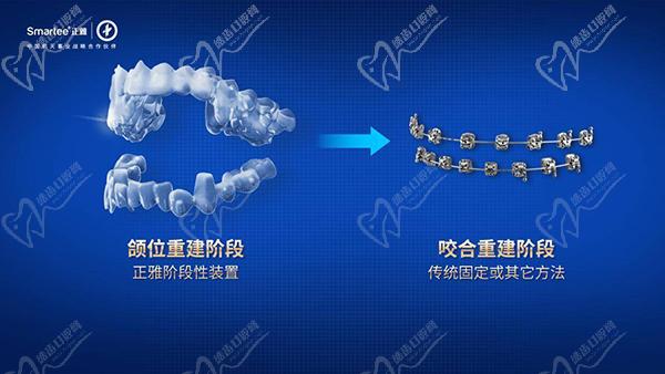 正雅s8頜位重建會(huì)反彈嗎要多久