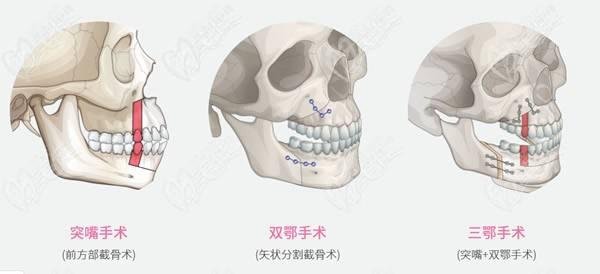 北京正頜手術(shù)費用能報銷嗎