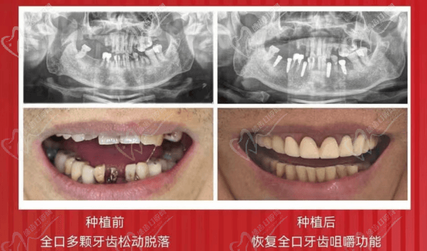 種植前后對(duì)比