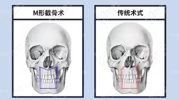 正頜直術(shù)比正頜手術(shù)會影響手術(shù)成效嗎