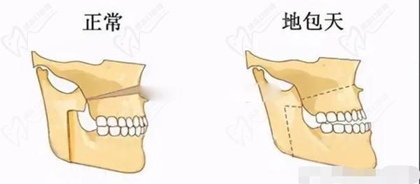 南京吳國平正頜手術(shù)怎么樣