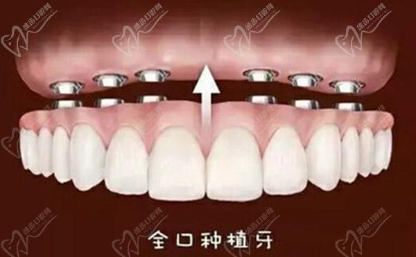全口種植