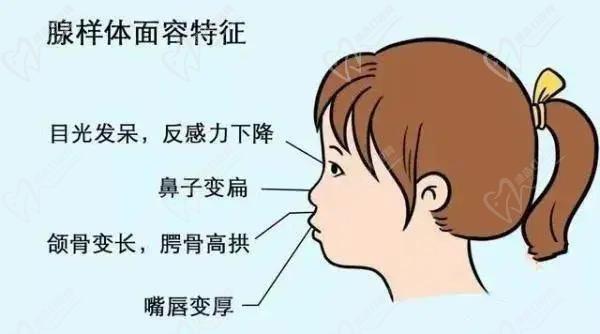 有種丑叫做腺樣體面容