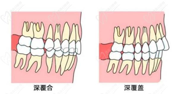 牙齒只深覆蓋正常嗎？深覆蓋有必要矯正嗎？看矯正后臉型變化