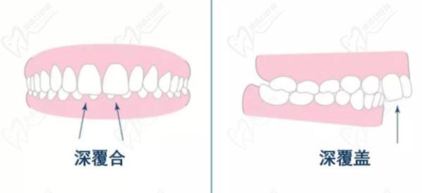 牙齒只深覆蓋正常嗎？深覆蓋有必要矯正嗎？看矯正后臉型變化