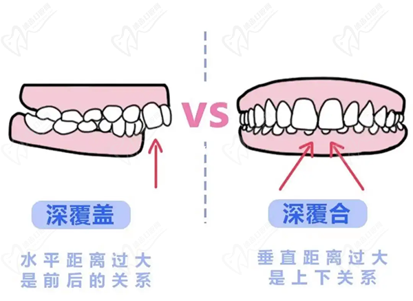 牙齒只深覆蓋正常嗎？深覆蓋有必要矯正嗎？看矯正后臉型變化