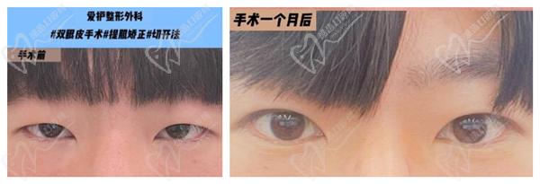 韓國愛護整形醫(yī)院眼修復(fù)