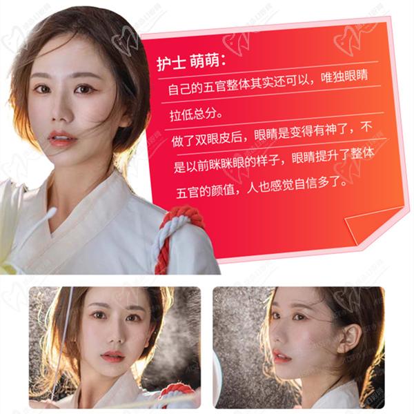 長沙愛思特雙眼皮手術圖