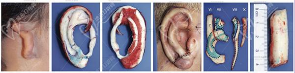 八大處耳再造手術哪個醫(yī)生好