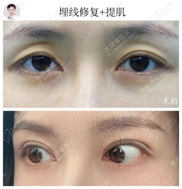 沈國雄眼修復真人實例圖
