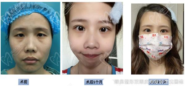 沈國雄眼修復真人實例圖