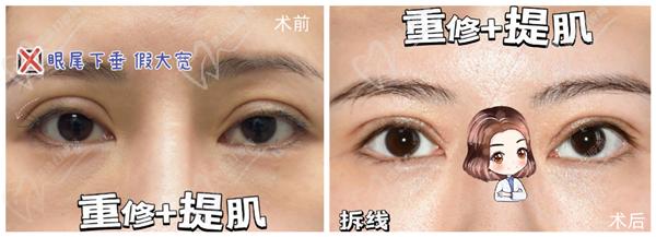 徐曉斐雙眼皮真人手術圖片