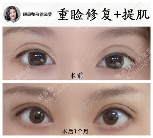 徐曉斐雙眼皮真人手術圖片
