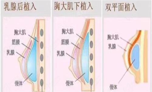 竇璽隆胸手術(shù)怎么樣