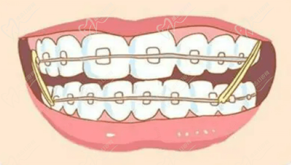 南京德牙聯(lián)合口腔普通托槽矯正價(jià)格