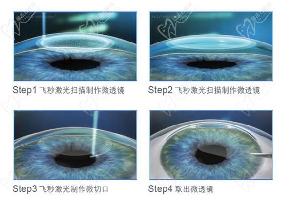 蔡司全飛秒smile3.0屈光矯正手術(shù)優(yōu)勢(shì)