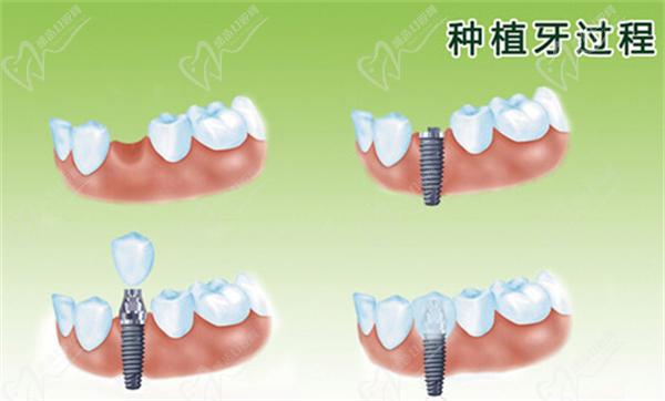 牙齒種植修復(fù)