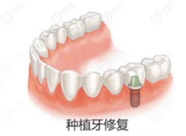 種植牙韓國(guó)和德國(guó)應(yīng)該怎么區(qū)別
