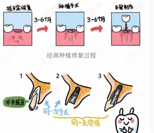 全口種植牙的優(yōu)勢(shì)