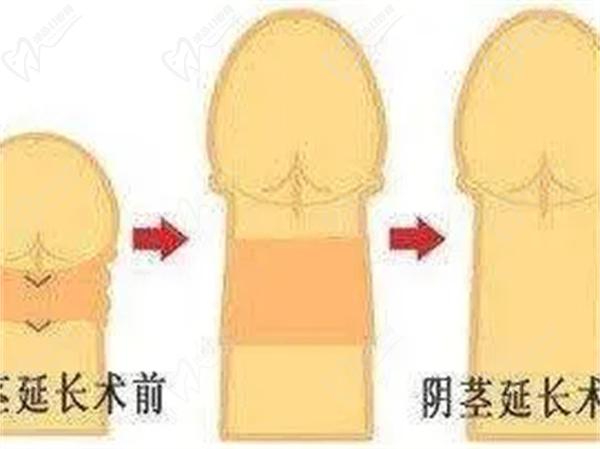 鄭州打玻尿酸增大需要多少錢