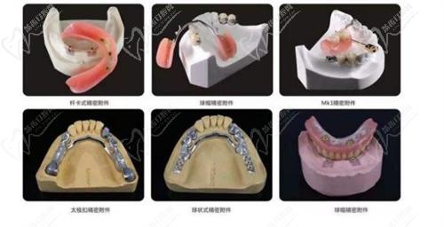 密附著體義齒適合什么牙