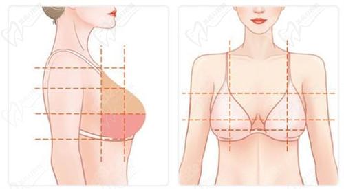 1、假體隆胸：塑造理想胸型