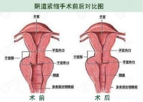 緊縮針多少錢(qián)一支哪里可以打