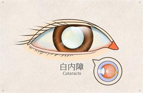 白內(nèi)障單焦晶體