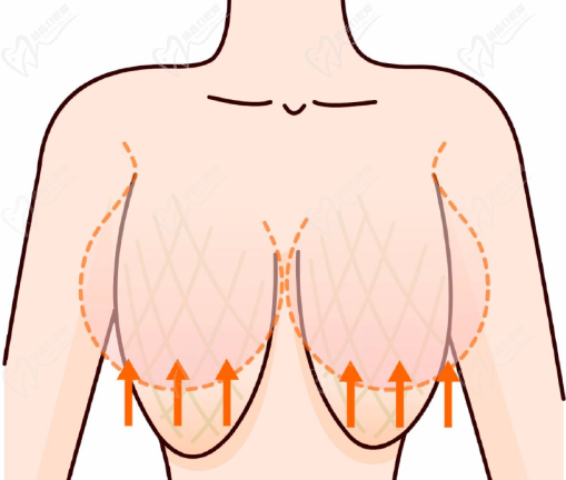 乳房縮小手術(shù)費(fèi)用多少錢(qián)