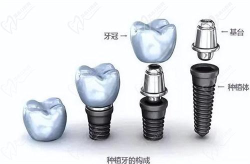 種一顆牙需要多少錢？