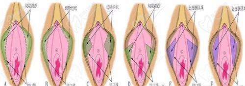 3d生物束帶多久能融合