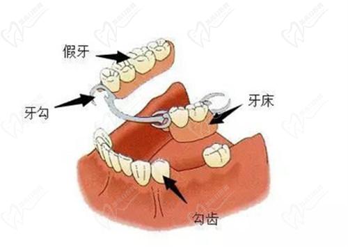 套筒冠義齒需要每天摘戴嗎？