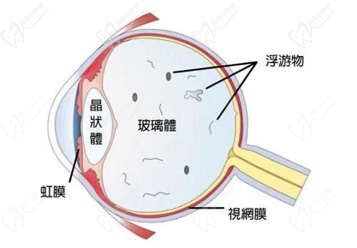 后鞏膜加固術后視力能提高多少