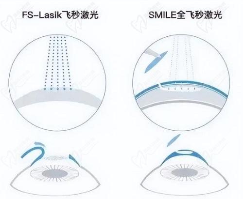 成都華廈眼科醫(yī)院陳曉明全飛秒近視手術(shù)