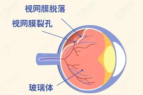 視網(wǎng)膜脫落可以治好嗎