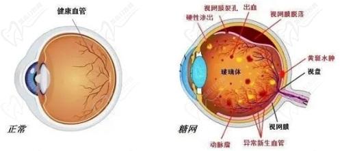 視網(wǎng)膜脫落可以治好嗎