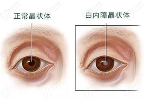 三、50歲近視又花眼能做手術(shù)嗎？