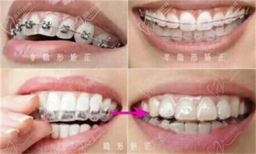 二、拜博口腔正畸價(jià)格的影響因素