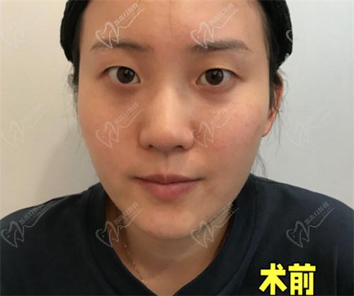 為什么選擇杜園園醫(yī)生做雙眼皮手術？