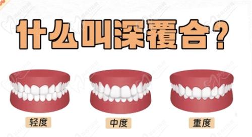牙齒深覆合一度二度三度區(qū)別圖片