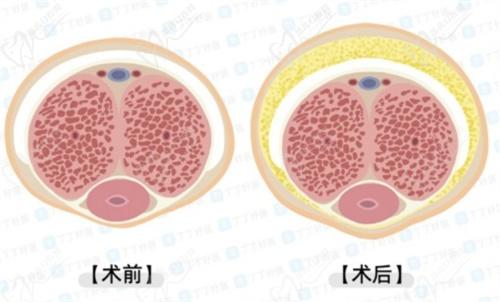 李世榮醫(yī)生做一次延長手術多少錢